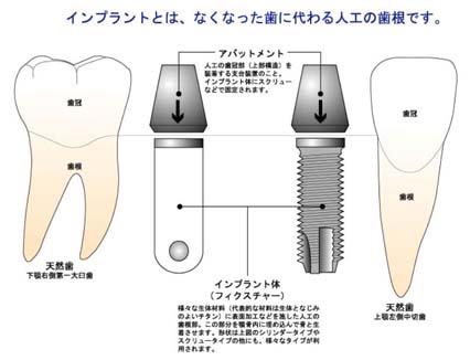 埼玉インプラントセンター・埼玉県鴻巣市/インプラントによる、かみ合わせの回復例