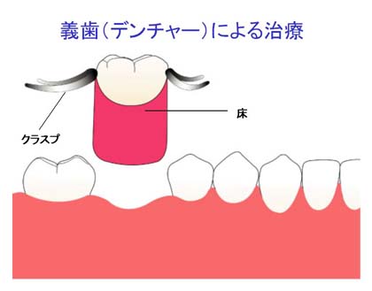 埼玉インプラントセンター・埼玉県鴻巣市/義歯(部分入れ歯)による、かみ合わせの回復例